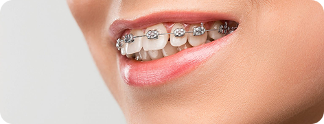 Benefits of Metal Braces