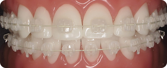 Advantages Braces Treatment
