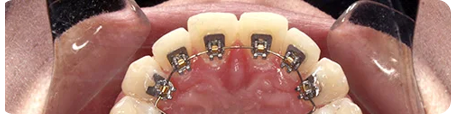 Lingual braces treatment in ahmedabad