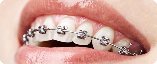 Benefits braces treatment