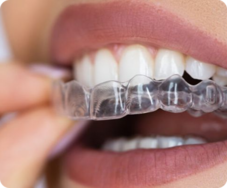 Benefits of Clear Aligners