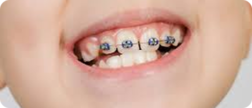 Children braces treatment in ahmedabad