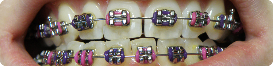 Dental Braces for Adults