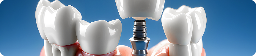 Dental Crown and Bridge
Treatment in Ahmedabad