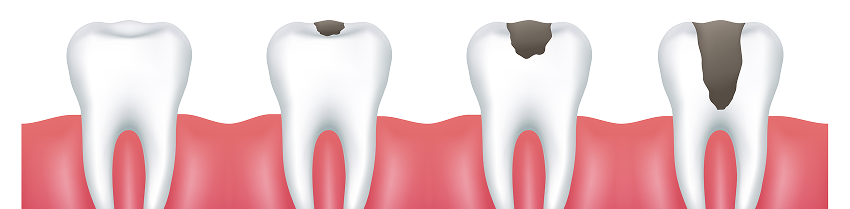 Dental fillings in Ahmedabad
