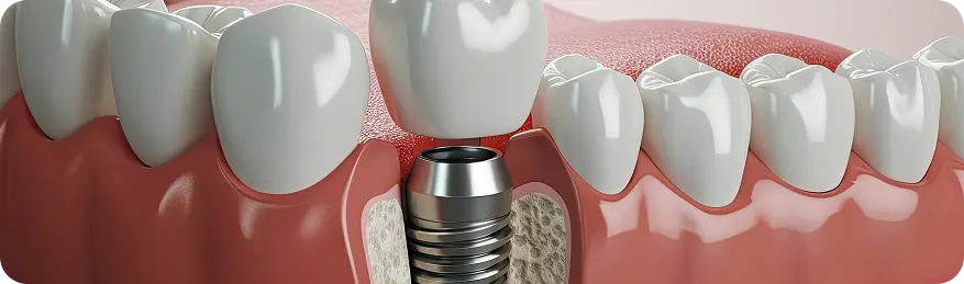 Dental Implant Safety and Treatment in Ahmedabad