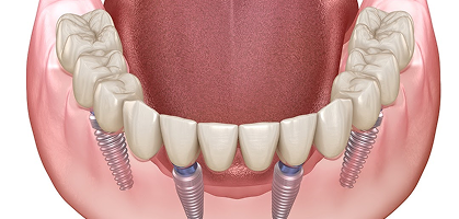 Full Mouth Rehabilitation