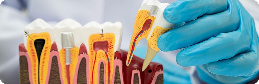 root canal treatment doctor in ahmedabad